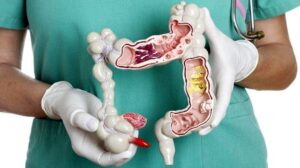 سرطان کولورکتال: آمار و نگرانی ها